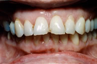 Veneers