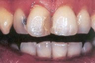 Veneers