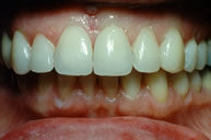 Veneers