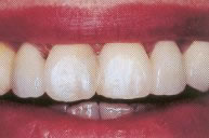 Veneers